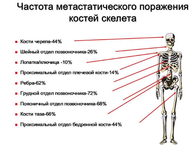Частота метастатического поражения костей скелета   Кости черепа-44%   Шейный отдел позвоночника-26%